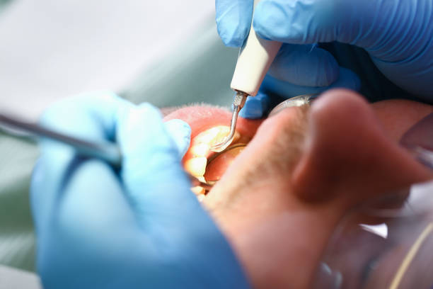 Best Emergency Dental Extractions in Colonial Heights, VA