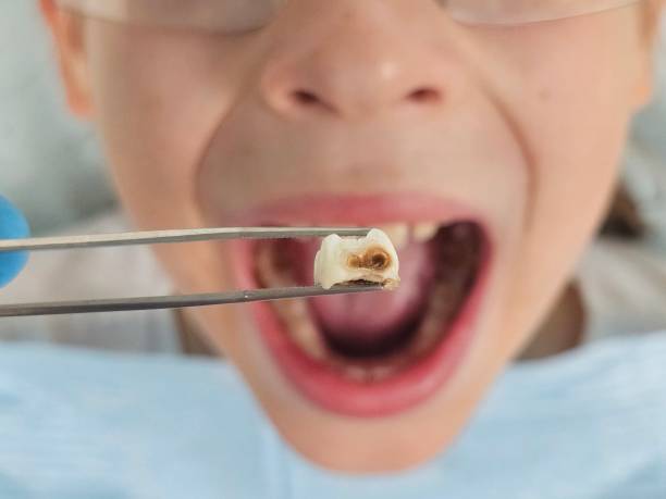 Best Emergency Dentist for Lost Fillings or Crowns in Colonial Heights, VA